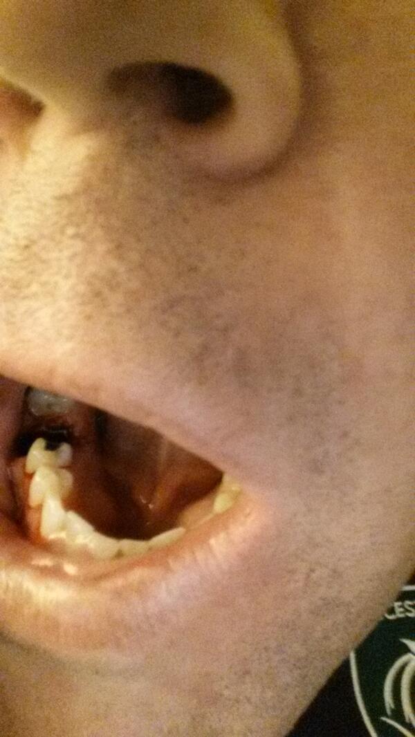 Fiddles79's tweet image. Spending an 1hr 20 m having a small Chinese dentist yank my tooth out til the point exhaustion is not my idea of fun.