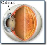 sarinascotti's tweet photo. Cataract involves intraocular lenses :For more information about  Cataract please visit :  
http://t.co/AhHU5vlbB9 http://t.co/x6GmKC53Tz