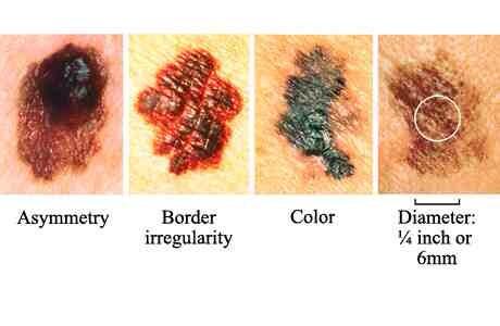 TesticularUK's tweet photo. Lads,I know we are testicular but #melanoma skin cancer is extremely dangerous so check the photo and learn symptoms http://t.co/tx9Xc26Gl1