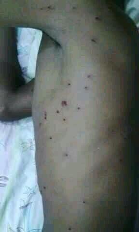 اصابه ثانيه بشوزن ف منطقة راس رمان <a href="/SAIDYOUSIF/">Sayed Yusuf Almuhafdha</a>