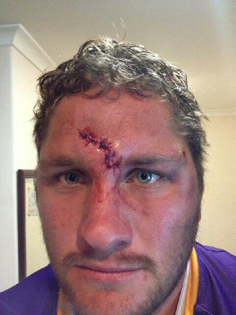 Chris4Ehlers's tweet photo. Life of a rugby player! http://t.co/Y0S1ZsnWji