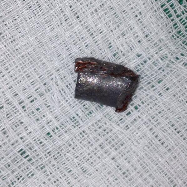 hissearnts's tweet photo. RT @blogdoneuro: Bullet removed from spine http://t.co/CErb0Jw7Aj #neurosurgery