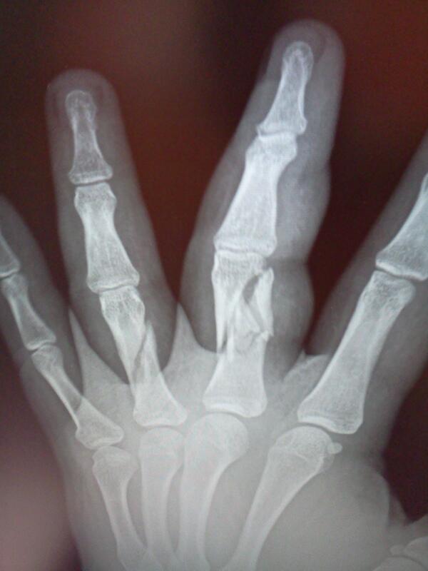 bignickV4L's tweet photo. This shit hurts. I broke two of my fingers. OWWWW!! http://t.co/qFMXQ2cusM