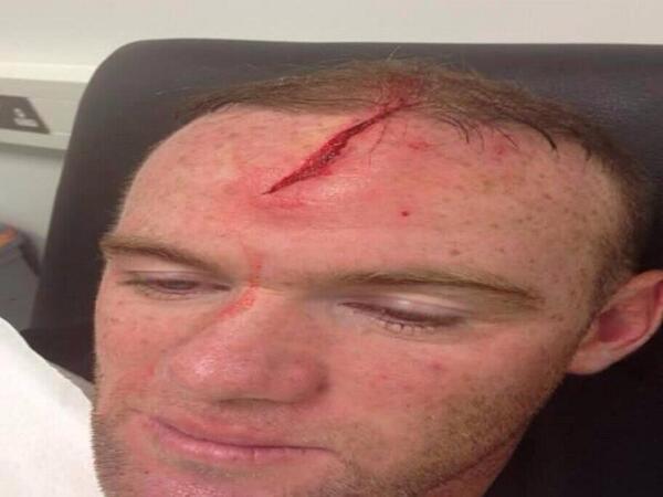 ManUtdStuff's tweet image. Rooney's scar on his forehead from accidental collision with Jones in training. (Warning: not for the faint hearted)