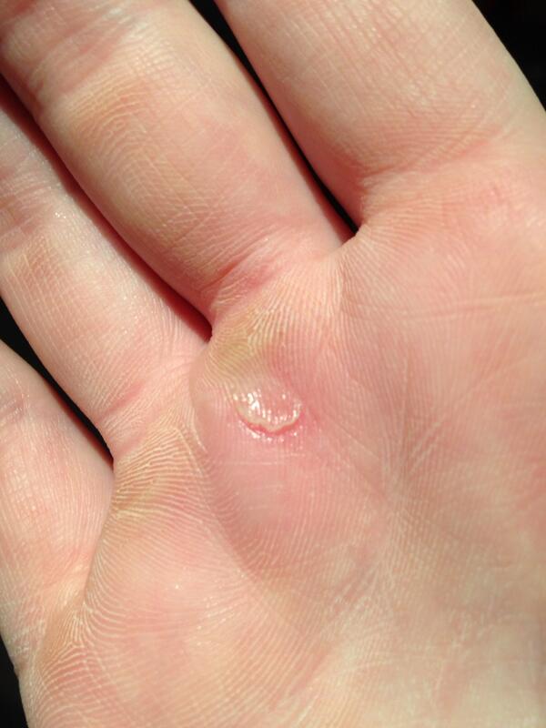 emma_caldwell_'s tweet image. My first pole dancing injury! It hurts soooooo much! 😢 #owchie