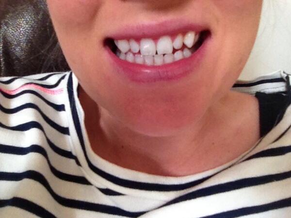 Abzred's tweet image. Gnashers coming along nicely, gonna look decent with a tan #whitening #treatfromamerica #gleeming