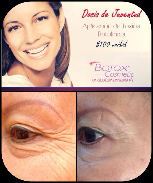 MedEsteticaDF's tweet photo. Del 9 al 12 de septiembre #botox 20% de descuento... @enladelvalle @NegociosRoma @NegociosCondesa  @NegociosNarvart http://t.co/IaPioWnw0z