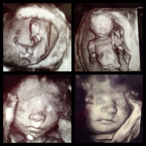 sammi_ivf_wife's tweet image. 3d pictures. 9weeks, 16weeks, 24weeks and 30weeks. #ivfmiracles #icsi