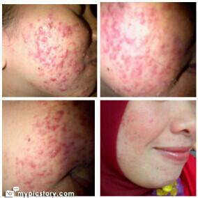 Best Seller!!! Melia Biyang mengatasi masalah Jerawat &amp; Komedo. Info &amp; Order Hp: 082110520434 PIN: 29EA3130