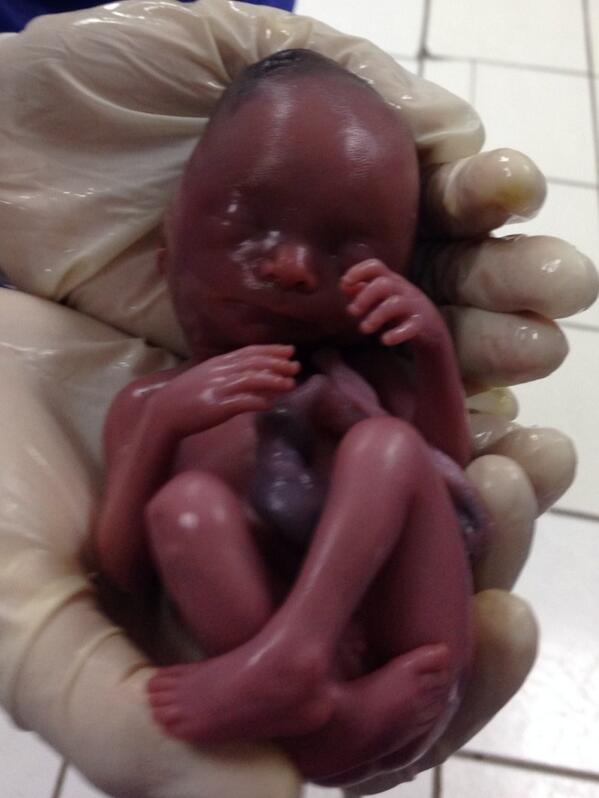 Erika9009Luna's tweet image. Close up of a 20 week old fetus! #fullydeveloped #unwanted #baby #medicine #cool #awesome