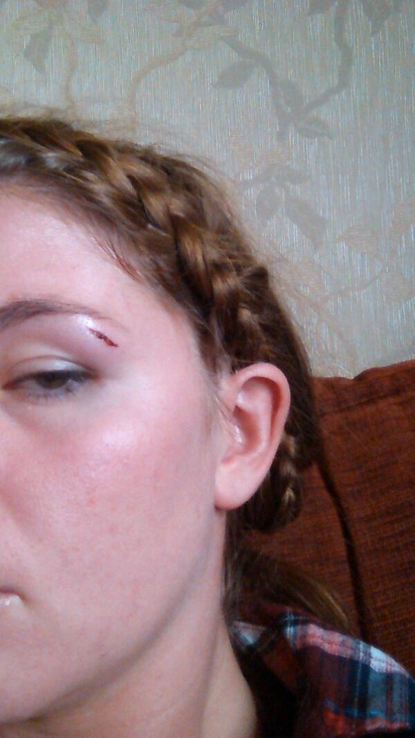 LgFester12's tweet image. Nice larl eye from last night thanks to Luke #headbut=spliteye