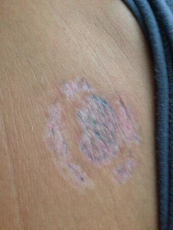 Tattoo removal update. Still some healing to go though sense the last session. http://t.co/IW2lKGtPi<a href="/tag/hotmess"class="tags"><span>#hotmess</span></a><a href="/tag/snickers"class="tags"><span>#snickers</span></a><a href="/tag/hangry"class="tags"><span>#hangry</span></a><a href="/tag/choclate"class="tags"><span>#choclate</span></a>