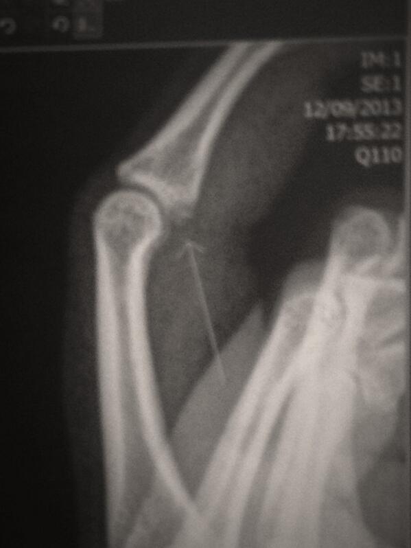 adele_dodd1's tweet image. It's official I have a fractured finger &amp;amp; can't play flag football for at least 3 weeks #Sad #FlagProblems