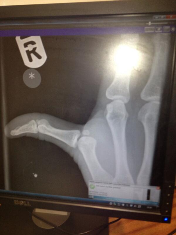 Broken man......AGAIN!! On the plus side a very fetching old lady splint.