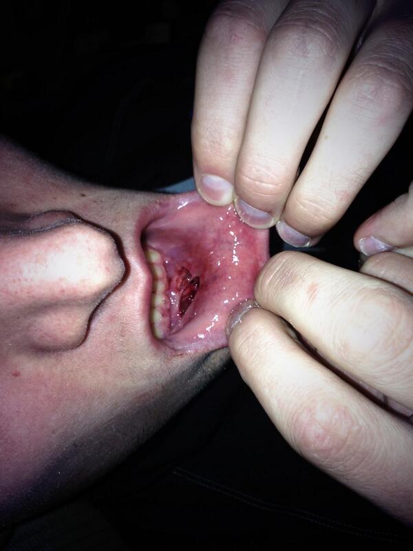 clambach69's tweet image. Jake jensens lip after the game #howthe? #ouch  #CSS