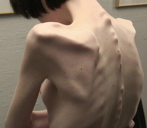 Видны ребра что делать. Повреждения грудной клетки травматология. Рентген ребер грудной клетки. Плоский животик. Перелом ребер грудной клетки.