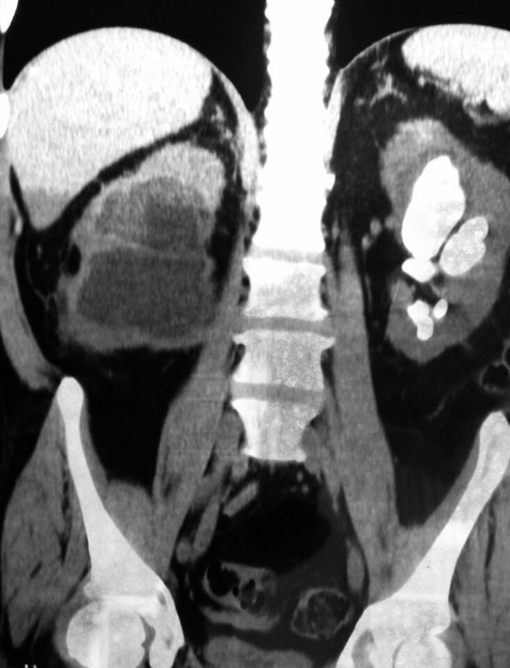 Lito coraliforme izquierdo