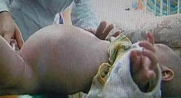 A3Noticias's tweet photo. Extraen del estómago de un niño de dos años el feto del que debería haber sido su gemelo http://t.co/bVu3yKgaFC http://t.co/YnZm1XquVb