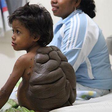 RipleyMX's tweet photo. NIÑO TORTUGA: Didier es un niño de 6 años que nació con un trastorno llamado "nevus melanocítico congénito". ¡CRÉALO! http://t.co/tDEFXWjugA