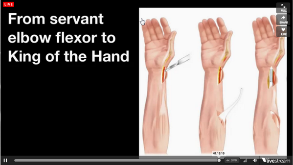 Medicoat (@medicoat) on Twitter photo RT <a href="/elGentscho/">Andi Gentsch</a>: Jan Fridén, Professor for Hand Surgery calls thumb the king of the hand #TEDxZurich RT <a href="/elGentscho/">Andi Gentsch</a>: Jan Fridén, Professor for Hand Surgery calls thumb the king of the hand #TEDxZurich