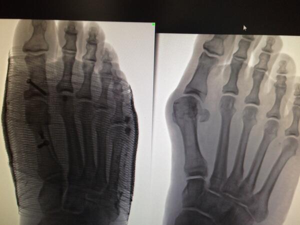 Vol_Trader's tweet photo. A patient just gave me a big hug after seeing her foot after surgery for the first time. Awe!! http://t.co/OyuEwSvrHG