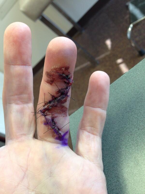 realjknoxville's tweet photo. This is what my finger looks like after having surgery 4 a ruptured tendon. Irving Zisman did this 2 me. Love,Knox http://t.co/VaueW6yWGA