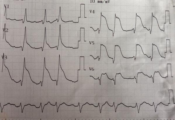 umanamd's tweet image. Correlation between magnitude of STE + LV failure + mortality: sadly, doesn’t look good…
#codeSTEMI