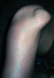 sharipettiii's tweet image. Exactly one year ago, this happened to my knee.. #Dislocated