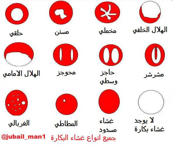 طبيب نساء On Twitter غشاء البكاره رقيق جدا يغلق فتحة المهبل وبه فتحة 