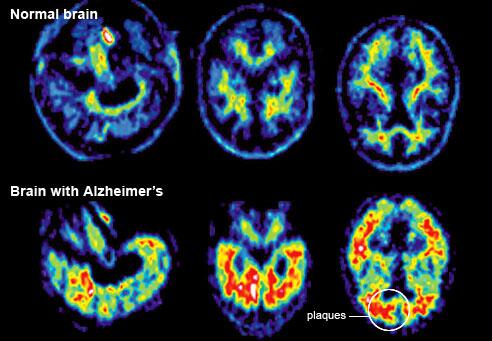Guiadent's tweet photo. Artículo en Guiadent: Estudio sugiere relación entre el Alzheimer y la periodontitis - Ver: http://t.co/pGPxkw7hBs  http://t.co/0LGuJUWbpD