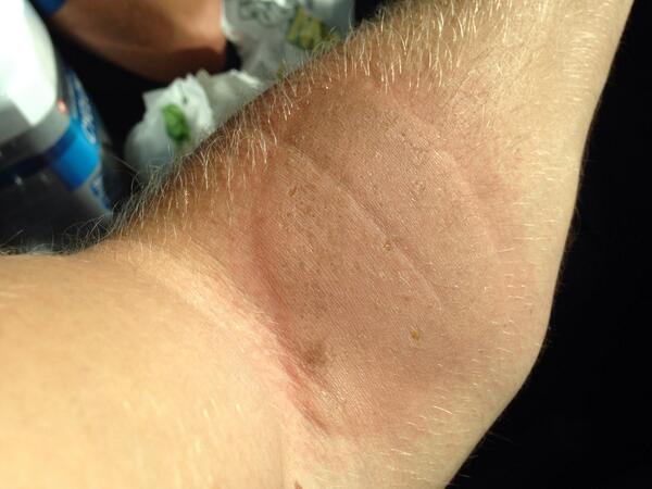 R_HOLT's tweet photo. You could say I've burnt my arm! That's what happens when you use a blow Torch hungover!! #FuckSake #WhyAlwaysMe http://t.co/mPa3SEfyMM