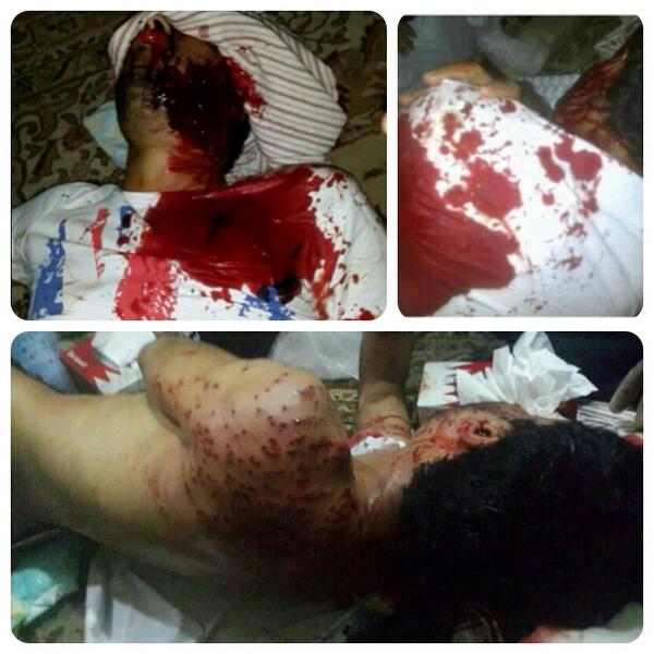 صورة إصابة حرجة برصاص الشوزن للشاب عبدلله حسن ياسين من قرية عالي