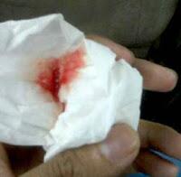 area_08's tweet photo. Tak dapat di pungkiri ternyata tubuh ini Lemah juga. http://t.co/oPfgjI7Nc3