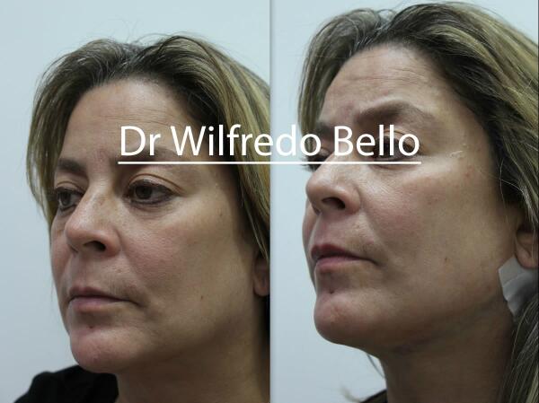 Endotine's tweet image. MT @DrWilfredoBello: Know that ENDOTINE RIBBON ® is for the neck?