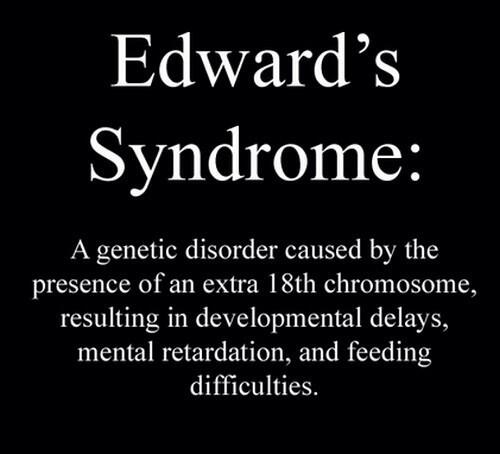 Dr_Dexterose's tweet image. #EdwardSyndrome