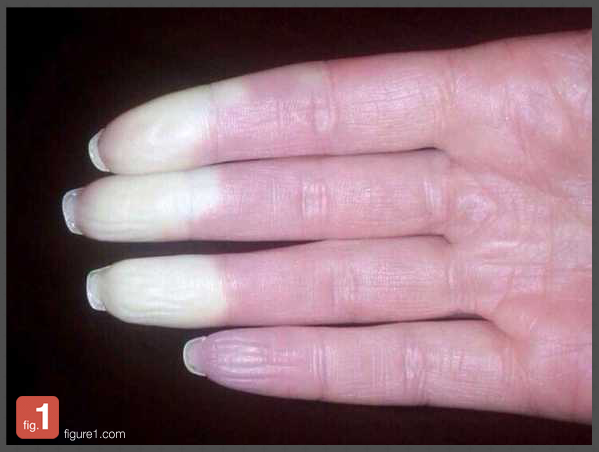 Figure1's tweet photo. Our medical image of the week shows a textbook case of Raynaud’s phenomenon. See Figure 1 to learn more. http://t.co/FbximZFD5S