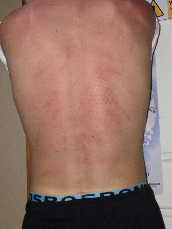 Distincct's tweet image. My back after #theamityaffliction last night letting people run and jump off my back ahaha!!!