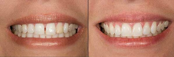 Are Gap-Toothed Smiles are a Hollywood Fad or Confidence Killer? More here: aacd.com/index.php?modu… #diastema