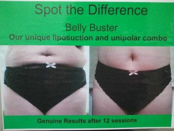 SlimmingLounge's tweet photo. @SlimmingLounge belly buster http://t.co/UKaEZUsZdp