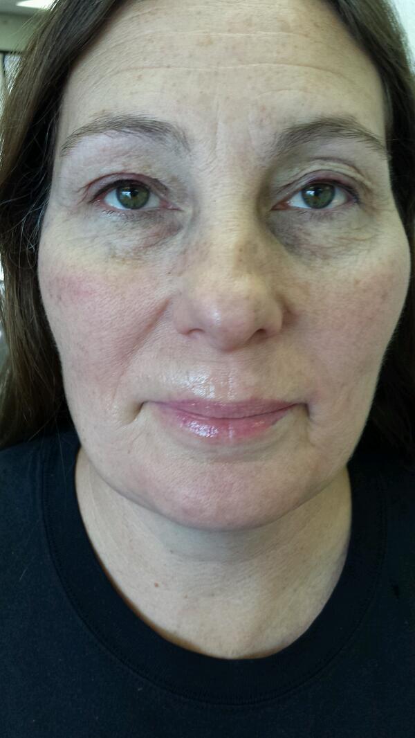 TheSkinStop's tweet photo. After-top liner and full lip shade.numbing agents make lips look paler and splotchy at first http://t.co/5qtoRfMnS9