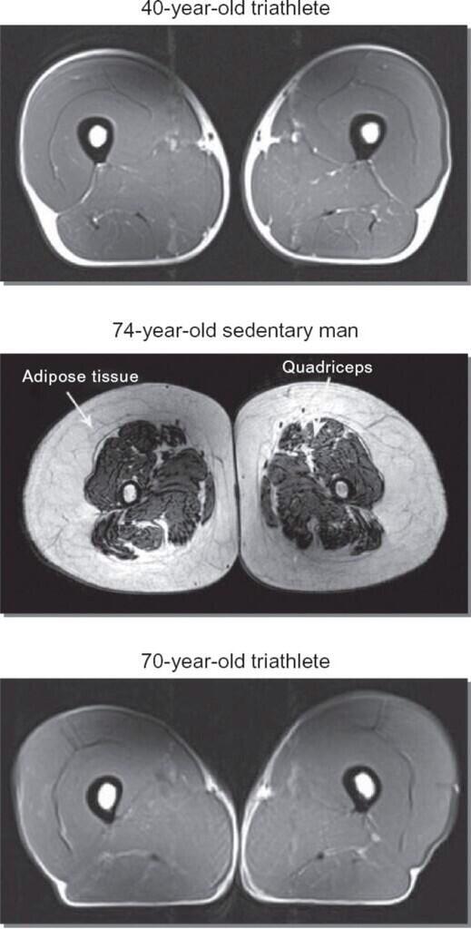advantagephysio's tweet photo. This is your quadriceps with exercise. This is your quadriceps without exercise. Any questions?: http://t.co/jIah0hdkev