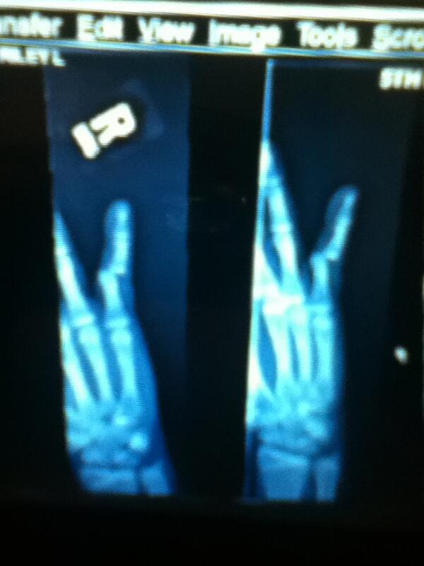 riley_decker's tweet image. Did this really have to happen the first day of practiced😡🏀😐 #dislocated#somad