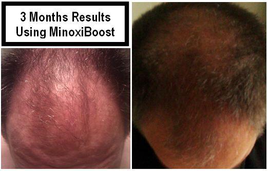 MinoxiBoost's tweet photo. #hairsalon #hairstyles #haircut #MinoxiBoost #hairloss #thinninghair #ChristmasGiftHour #BlackFriday #freeshipping http://t.co/Eia53hx9tL