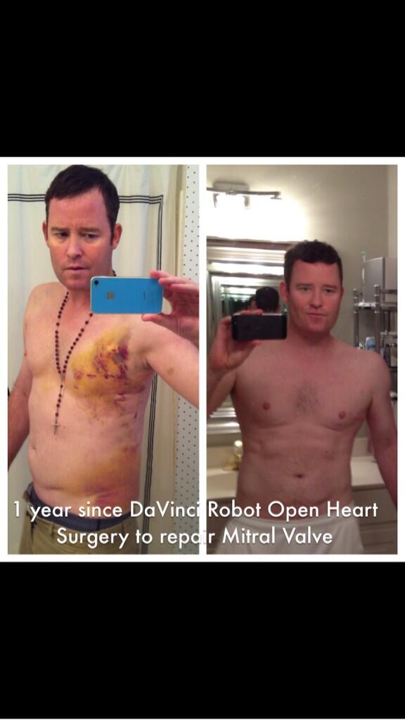 jamesRaaron's tweet photo. It's been a long year. Thank you for fixing my heart @marcrkatz  #BSHVI http://t.co/aDCwr12MLa