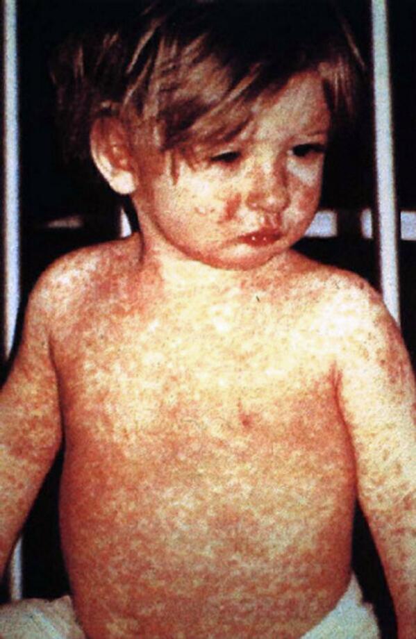 CPHA_ACSP's tweet photo. Why you want your kids immunized against #measles. This child shows a classic day #4 measles rash. http://t.co/WiLgFmvvb3