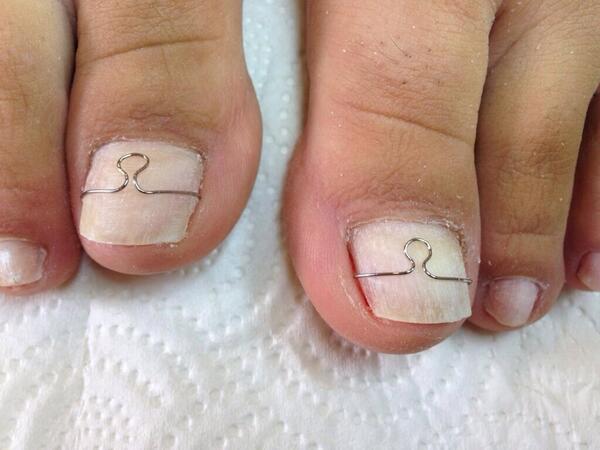 BATIK TIRNAK'larınıza S-TEL yöntemi ile çözümler üretiyoruz.Ameliyatsız,Ağrısız .TIRNAĞINIZI ÇEKTİRMEYİN!