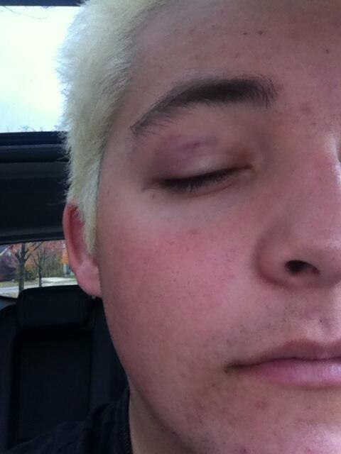 JenkinMatt's tweet image. I mean you wanna talk about a fucked up eye the next morning #hurtslikeabitch #gnawed #stillgottheW