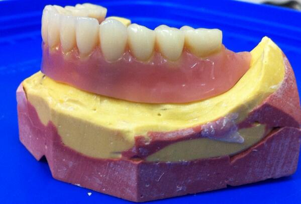 dental_molina's tweet image. Prótesis inferior #implanto-muco soportada con sistema de anclaje sobre locator.