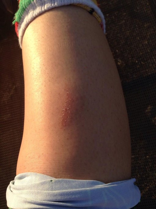 Don't text and hike 😞 http://t.co/vIBL3dtOFK