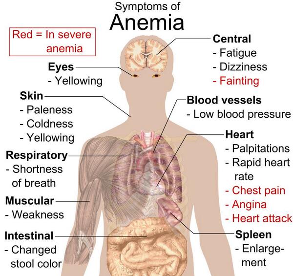 Symptoms of Anemia.
Manage your health by becoming alkaline:  DietToAlkaline.com
Found at buff.ly/1c50Hye